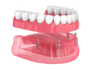 Full set implant-supported dentures